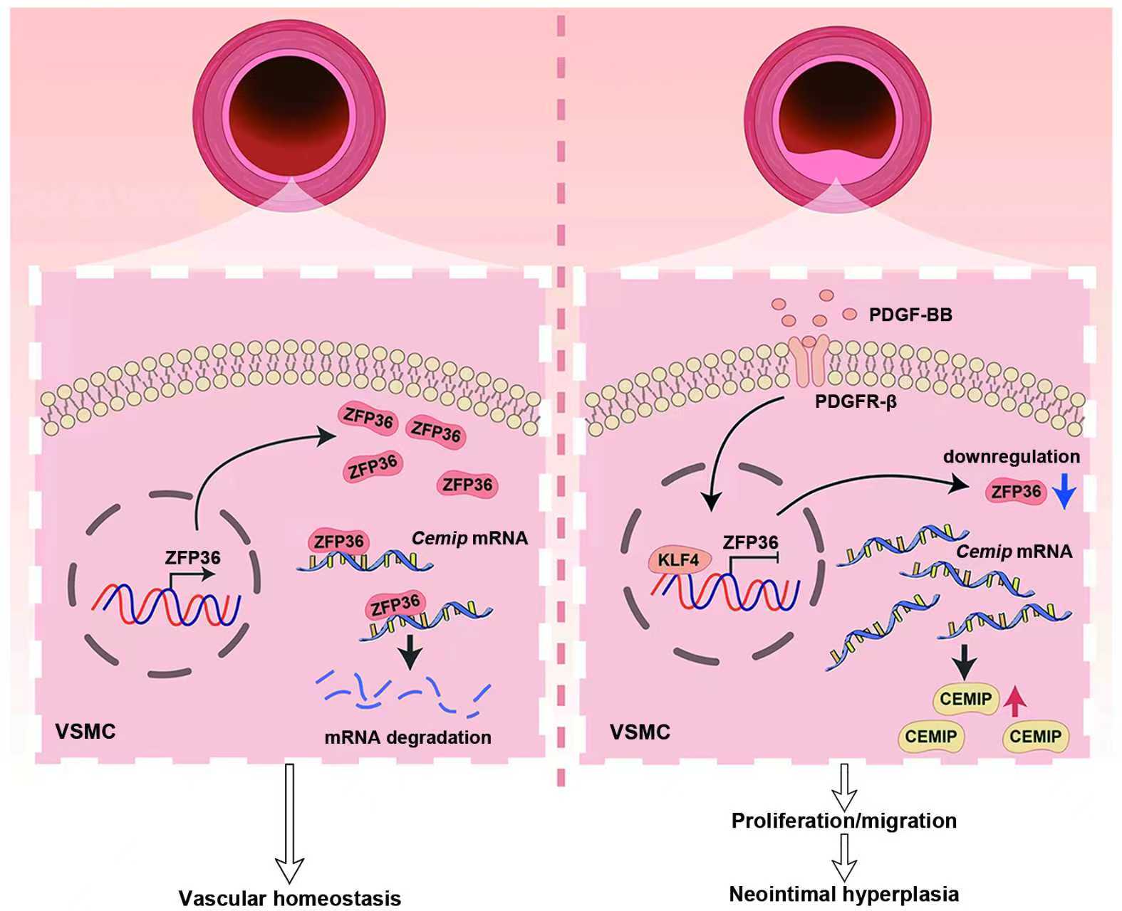 Deletion of smooth muscle ZFP36 promotes neointimal hyperplasia in mice